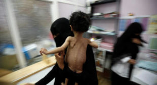 ‘Brutally honest’: Public outcry forces Facebook to stop banning pics of starving Yemeni girl